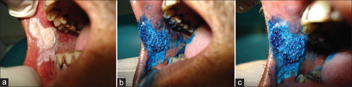 Kleuring van mondkanker